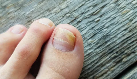 Fungal Nail Test £45